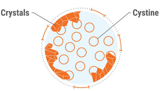 Cystinosis-graph